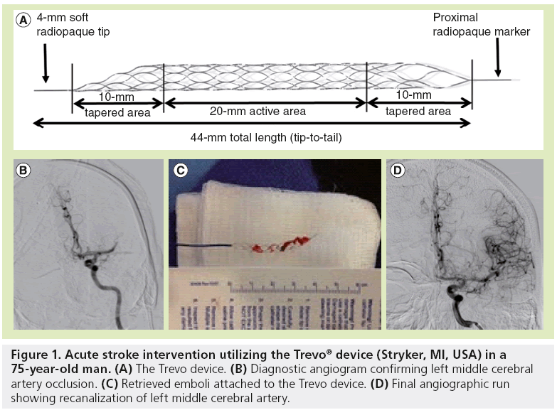 interventional-cardiology-Acute-stroke-intervention