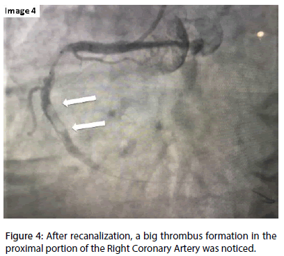 interventional-cardiology-After-recanalization