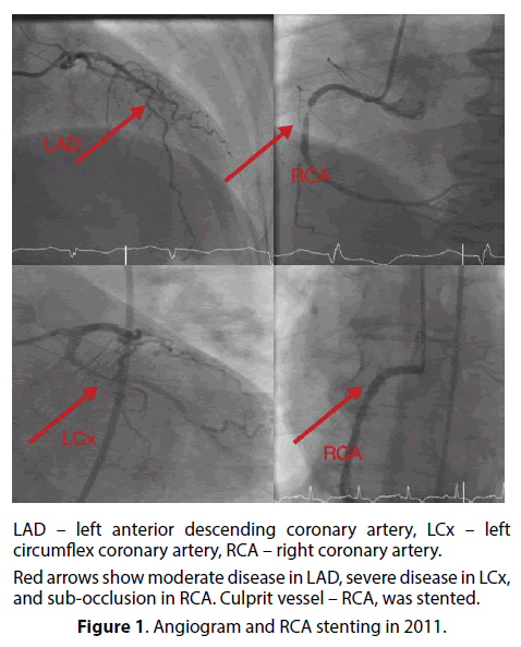 interventional-cardiology-Angiogram-RCA