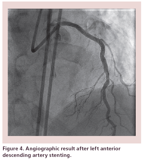 interventional-cardiology-Angiographic-result-after-left-anterior