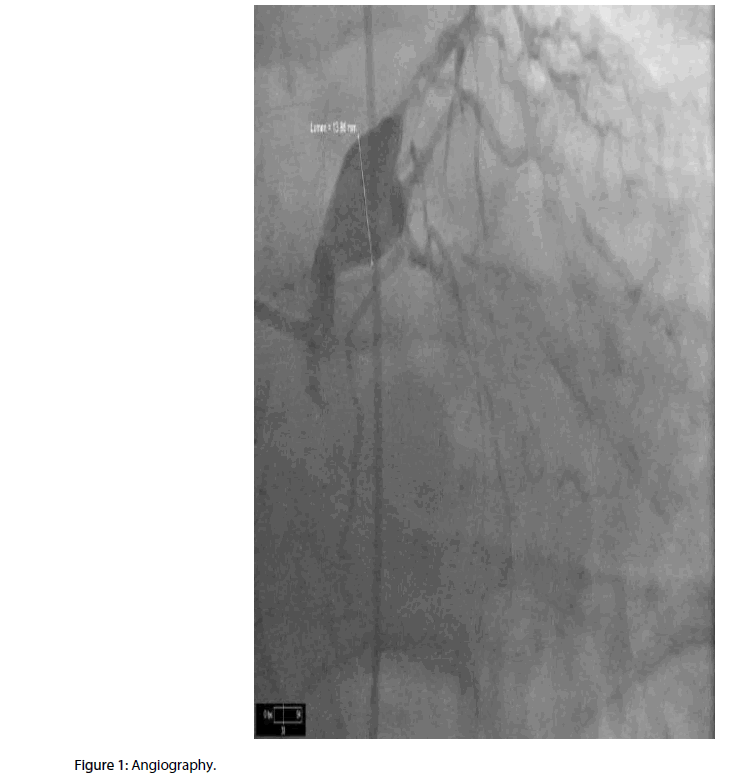 interventional-cardiology-Angiography