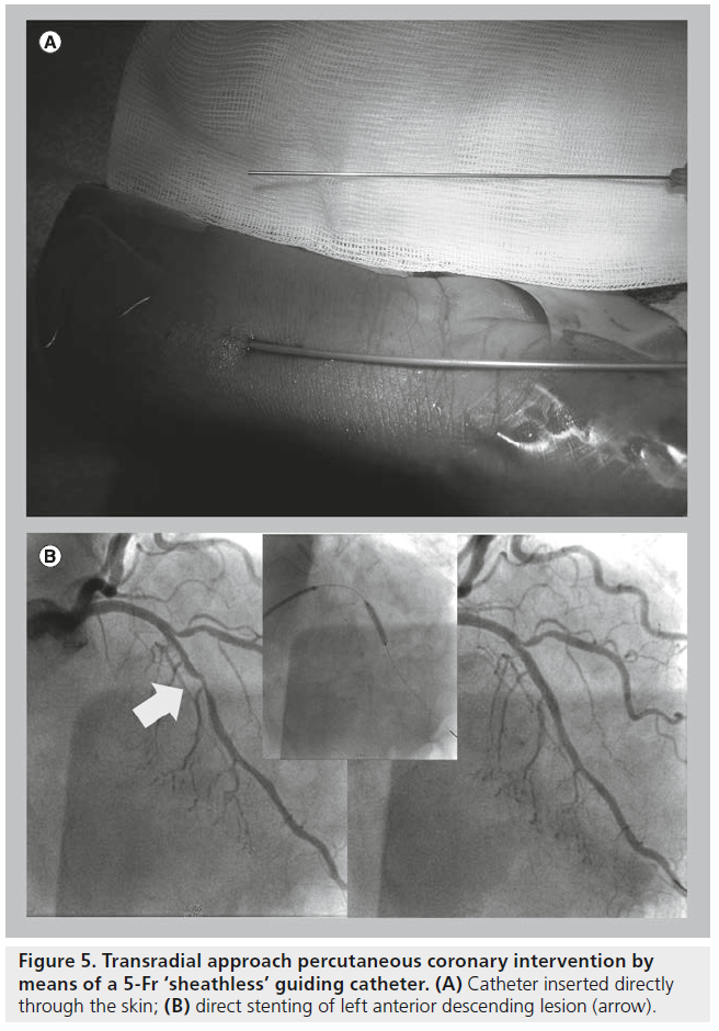 interventional-cardiology-Angiography-patent