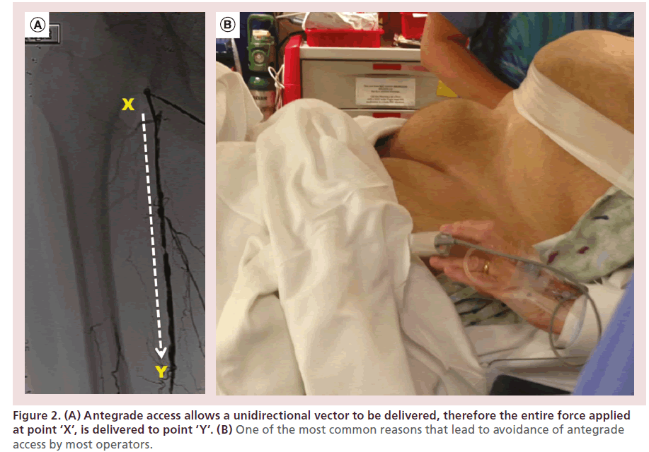 interventional-cardiology-Antegrade-access