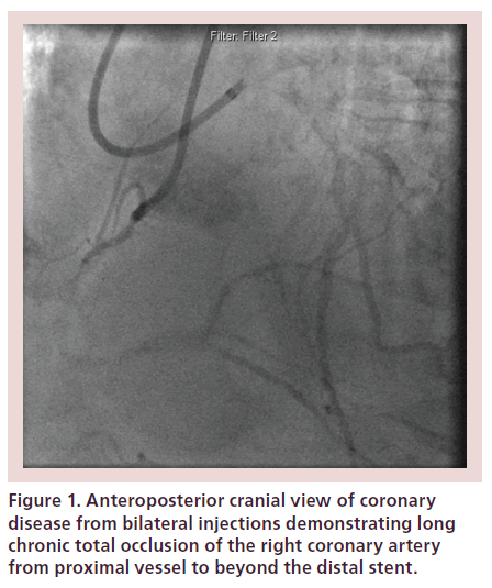 interventional-cardiology-Anteroposterior-cranial-view