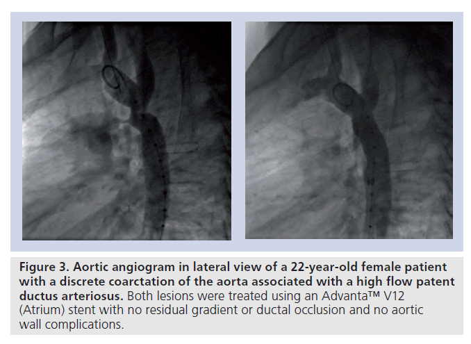 interventional-cardiology-Aortic-angiogram