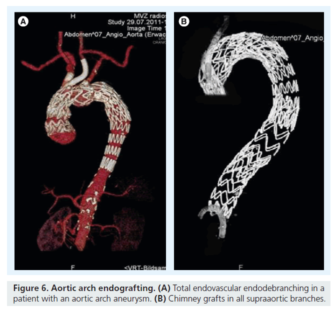 interventional-cardiology-Aortic-arch