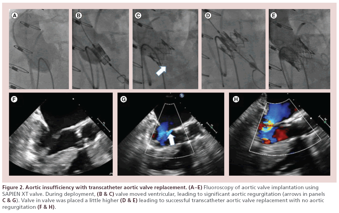 interventional-cardiology-Aortic-insufficiency-transcatheter