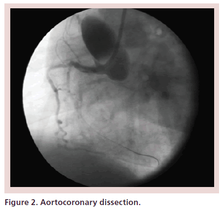 interventional-cardiology-Aortocoronary-dissection