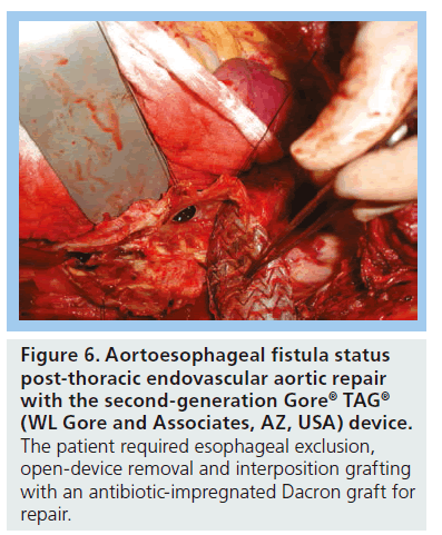 interventional-cardiology-Aortoesophageal-fistula