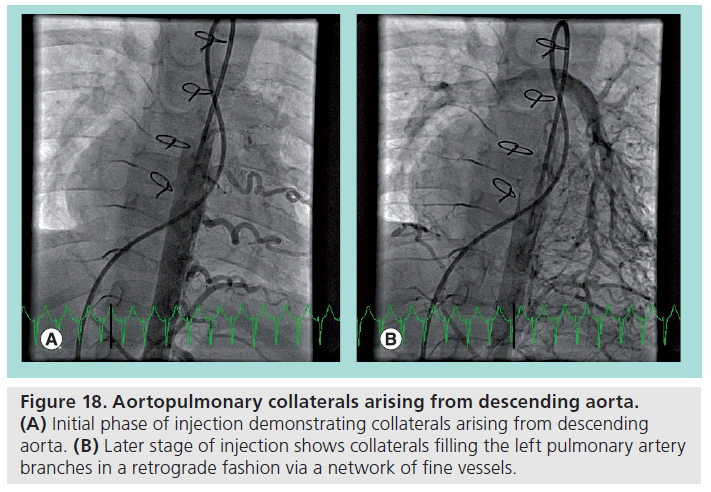 interventional-cardiology-Aortopulmonary-collaterals