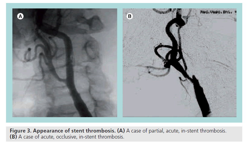 interventional-cardiology-Appearance-stent