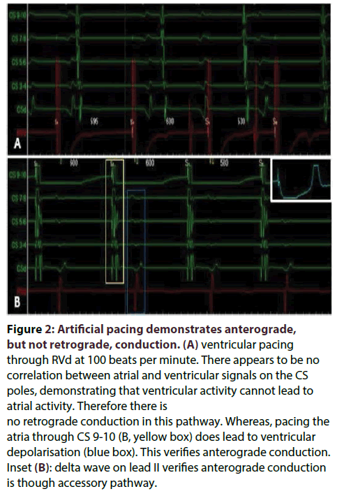 interventional-cardiology-Artificial-pacing