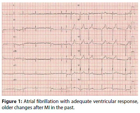 interventional-cardiology-Atrial-fibrillation