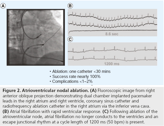 interventional-cardiology-Atrioventricular-nodal-ablation