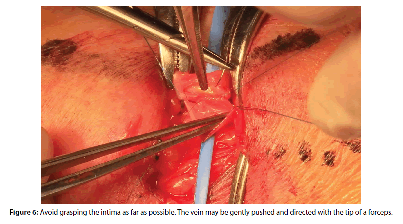 interventional-cardiology-Avoid-grasping
