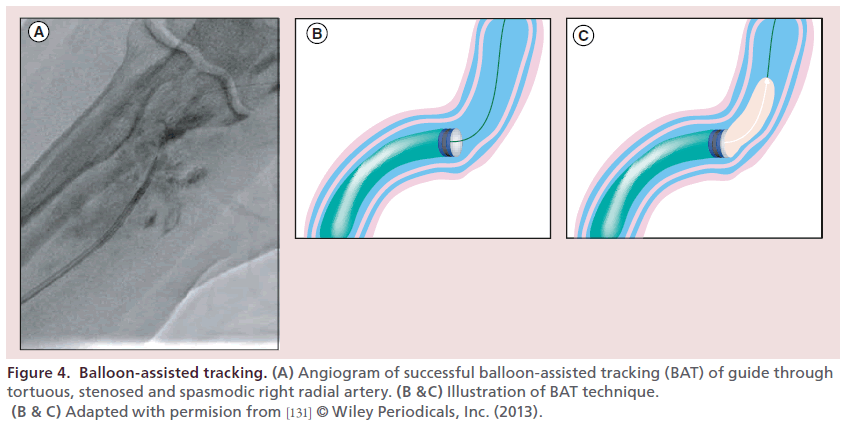 interventional-cardiology-Balloon-assisted-tracking