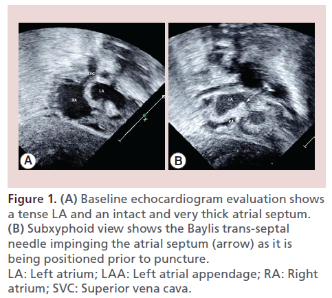 interventional-cardiology-Baseline-echocardiogram