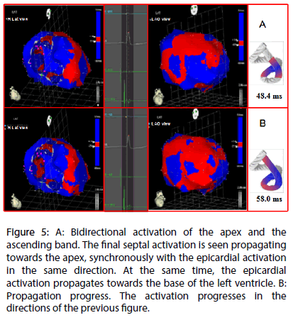 interventional-cardiology-Bidirectional-activation