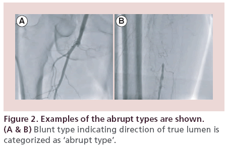 interventional-cardiology-Blunt-type-indicating