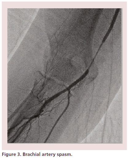 interventional-cardiology-Brachial-artery-spasm