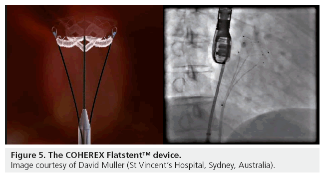 interventional-cardiology-COHEREX-Flatstent