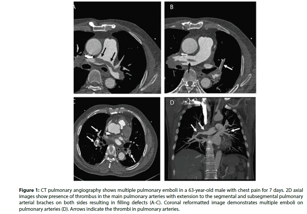 interventional-cardiology-CT-pulmonary