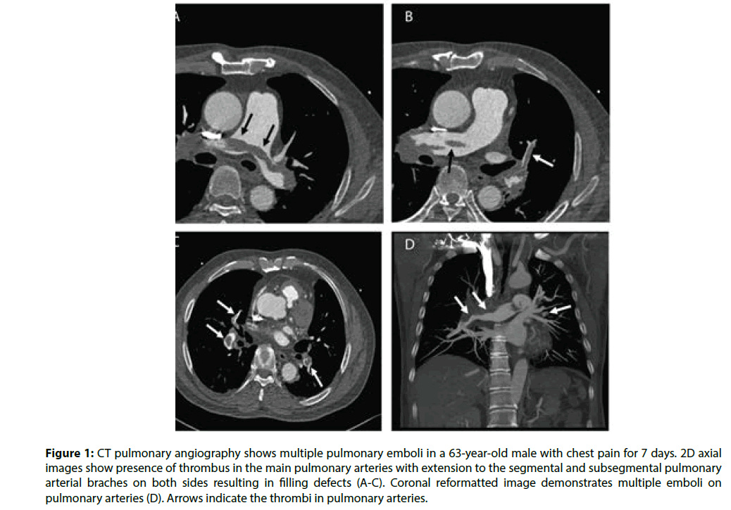 is neuroendocrine tumors cancer rare