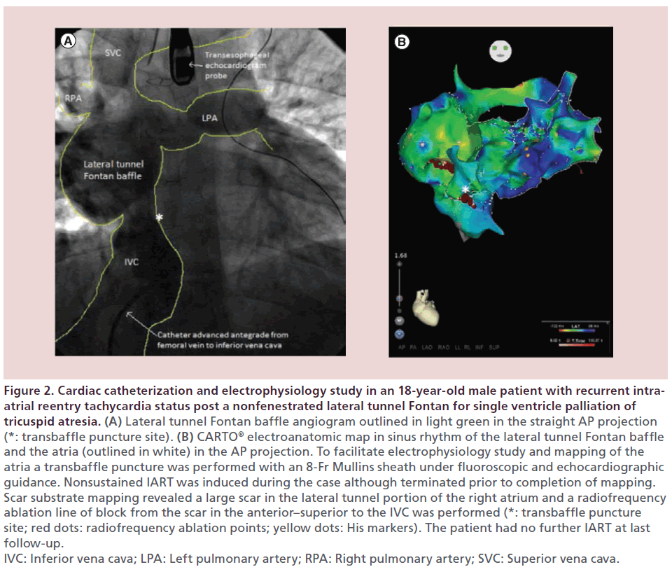 interventional-cardiology-Cardiac-catheterization