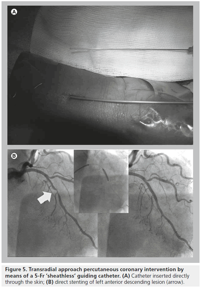 interventional-cardiology-Catheter