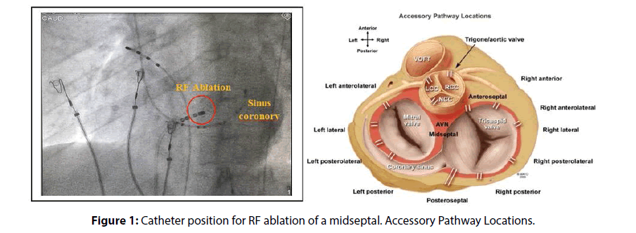 interventional-cardiology-Catheter-position