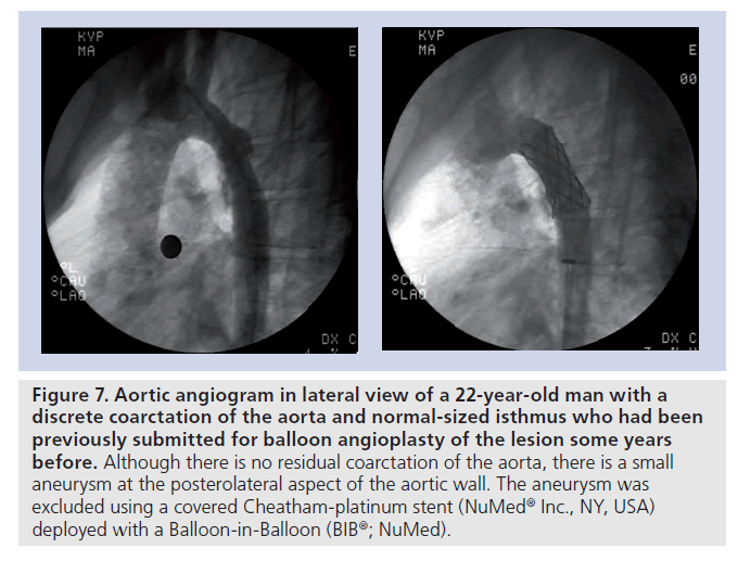 interventional-cardiology-Cheatham-platinum