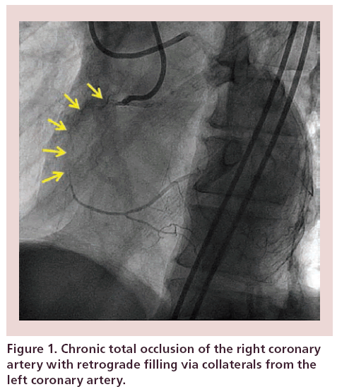 interventional-cardiology-Chronic-total-occlusion
