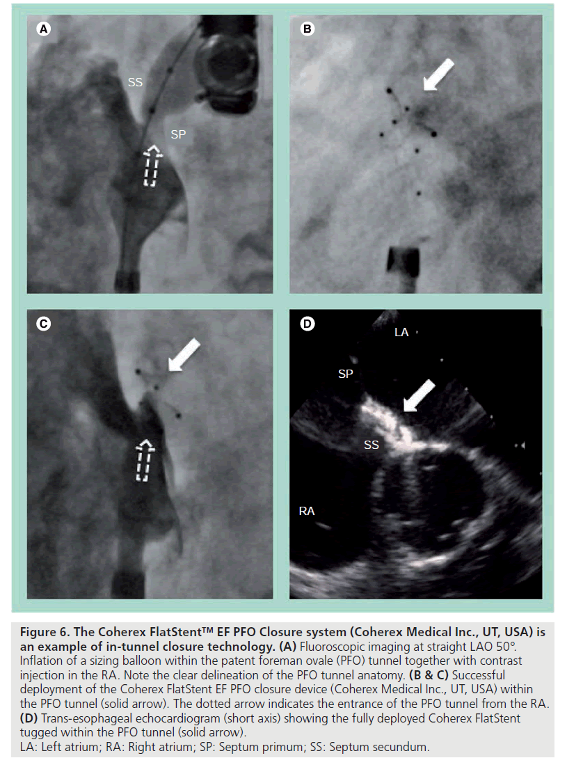 interventional-cardiology-Closure-system