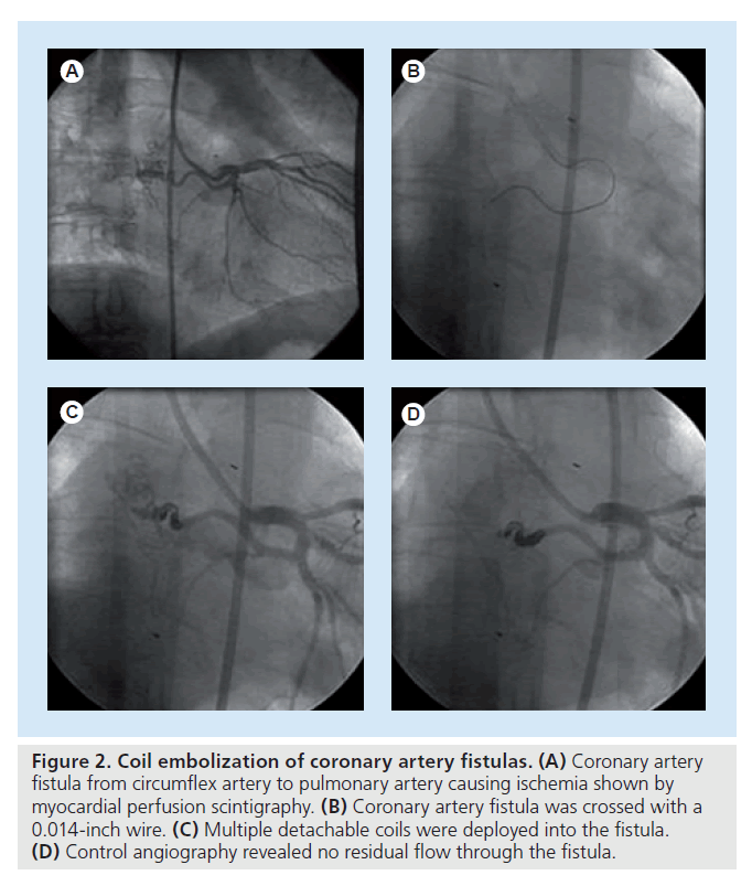 interventional-cardiology-Coil-embolization