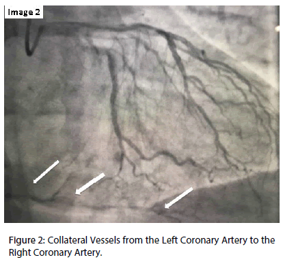 interventional-cardiology-Collateral-Vessels
