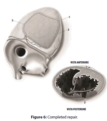 interventional-cardiology-Completed-repair