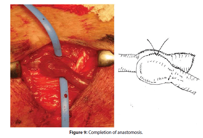 interventional-cardiology-Completion-anastomosis