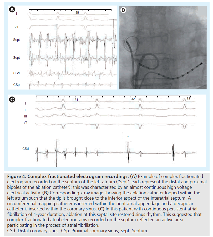 interventional-cardiology-Complex-fractionated