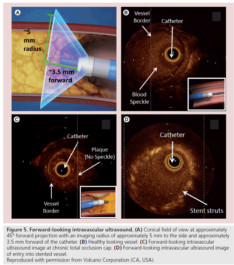 interventional-cardiology-Conical-field