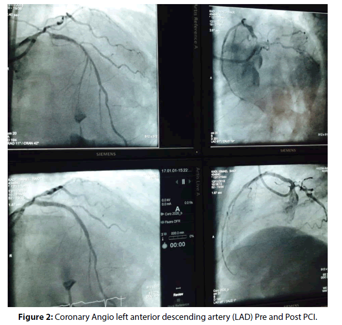 interventional-cardiology-Coronary-Angio