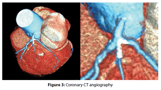 interventional-cardiology-Coronary-CT
