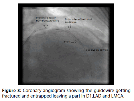 interventional-cardiology-Coronary-angiogram