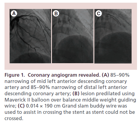 interventional-cardiology-Coronary-angiogram