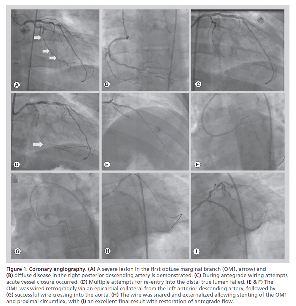 interventional-cardiology-Coronary-angiography