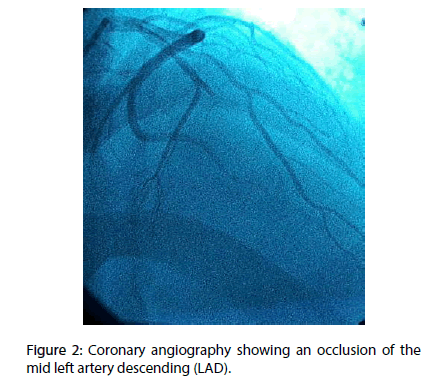 interventional-cardiology-Coronary-angiography