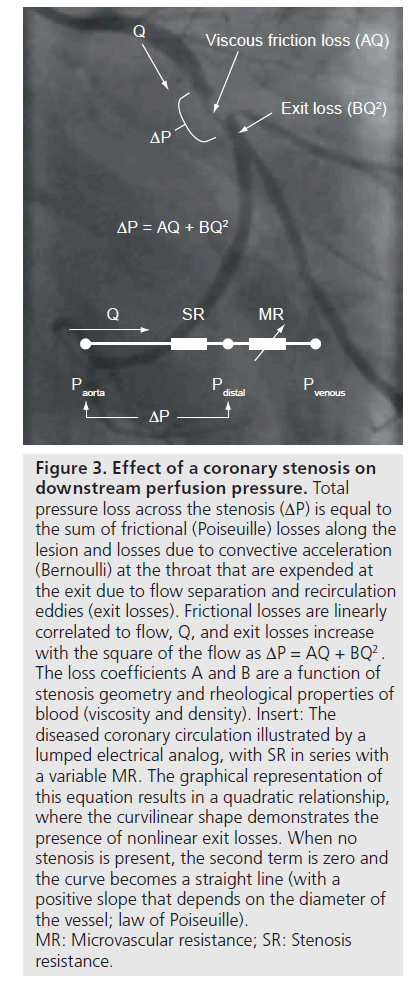 interventional-cardiology-Coronary-stenosis