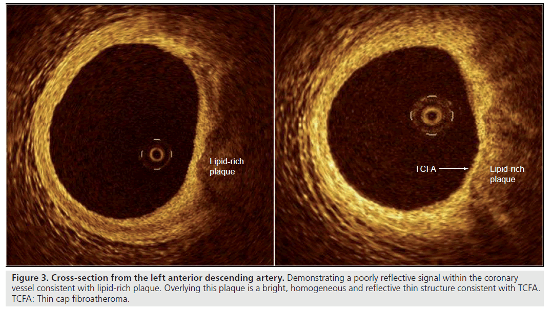 interventional-cardiology-Cross-section