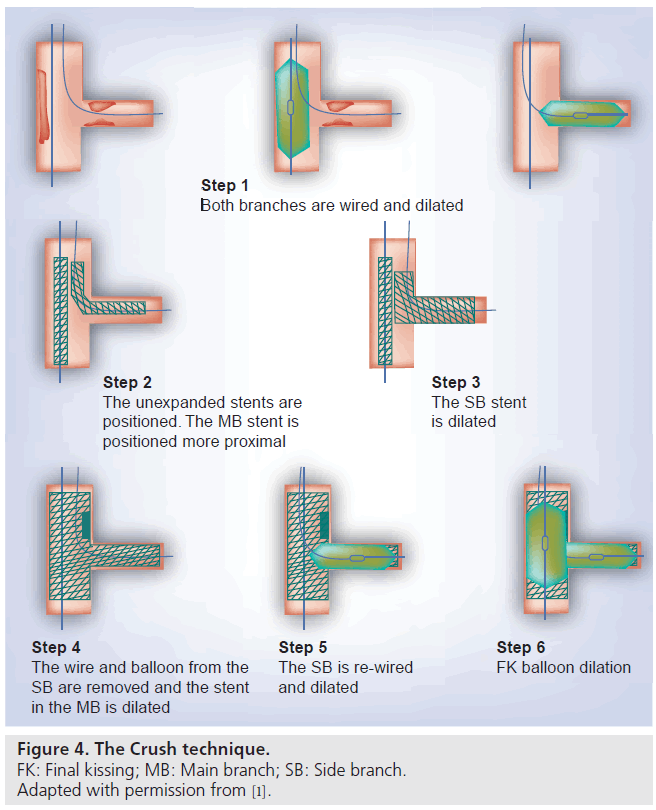 interventional-cardiology-Crush-technique