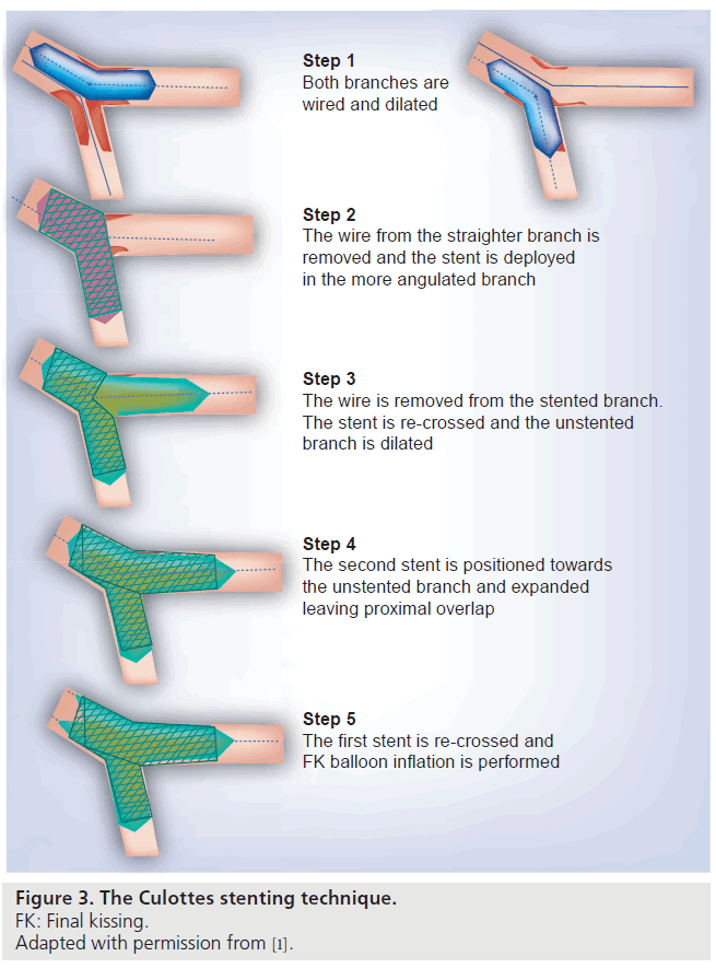 interventional-cardiology-Culottes-stenting