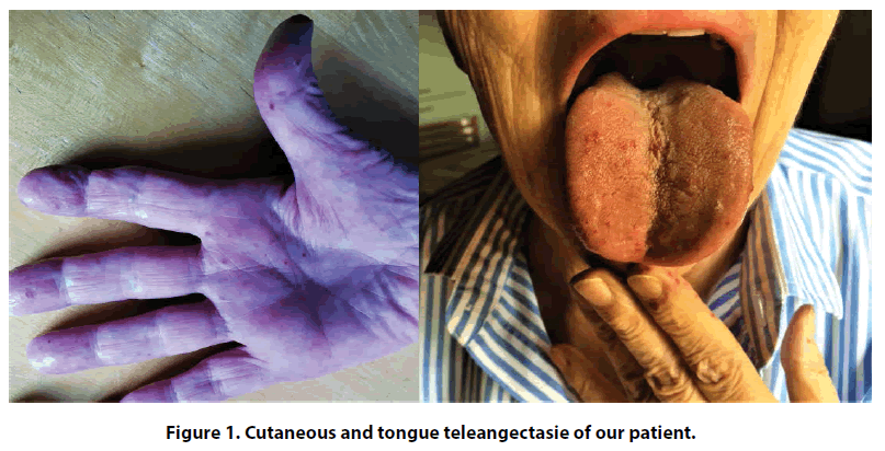 interventional-cardiology-Cutaneous-tongue